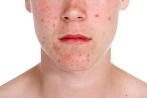 Acné adolescente varón