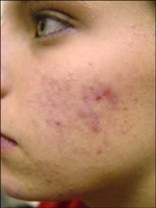 acné-sin-tratamiento